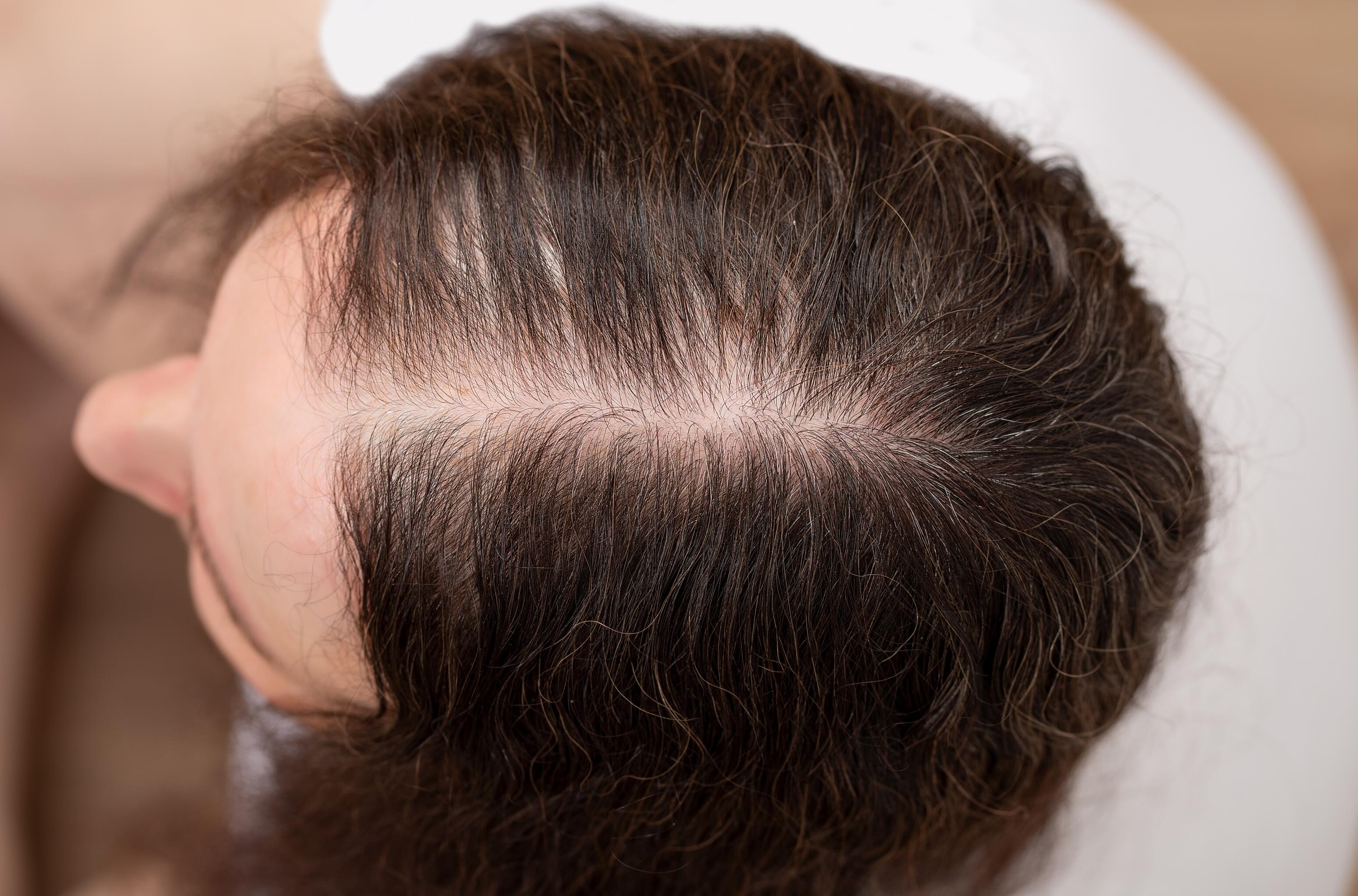 Perte de cheveux chez la femme